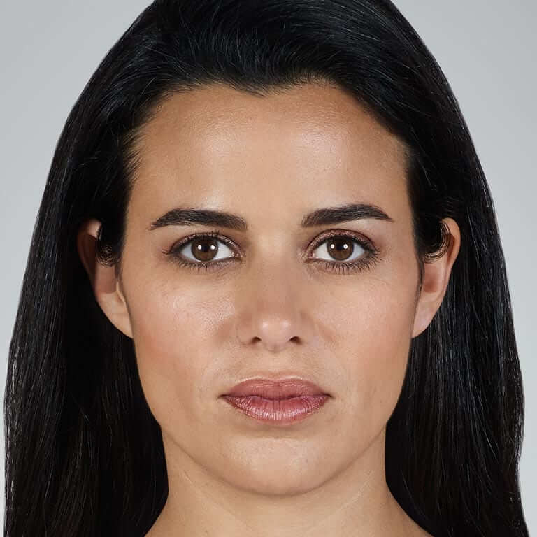 Juvederm results after on female model