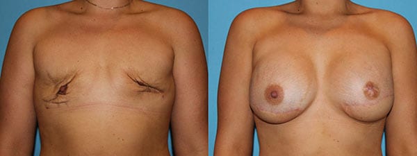 Before and After Breast Reconstruction