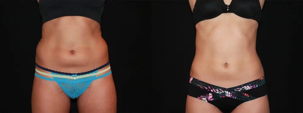 Coolsculpting before and after 