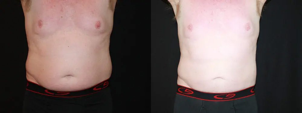 Coolsculpting before and after 2