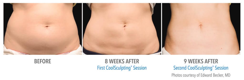 Before and afters taken 6 & 9 weeks apart. Courtesy of Edward Becker, MD