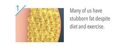 1. Many of us have stubborn fat despite diet and exercise. 