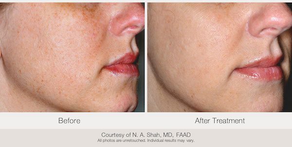 Laser Treatments Oxford MS Shell Plastic Surgery