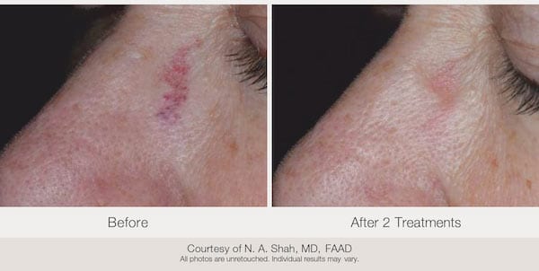 Before and after. Taken after 2 treatments. Courtesy of N. A. Shah, MD, FAAD