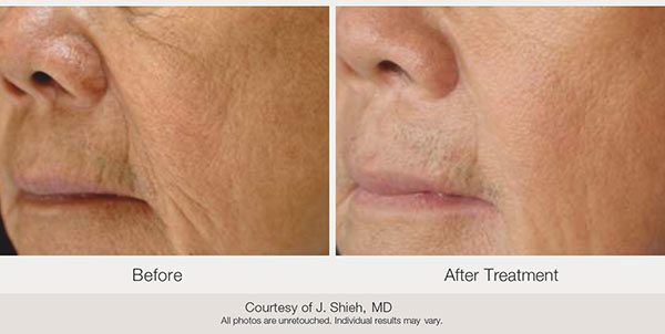 Laser Treatments Oxford MS Shell Plastic Surgery