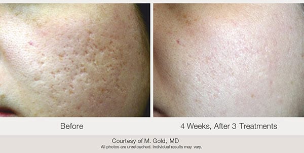 Skin care treatment before and after