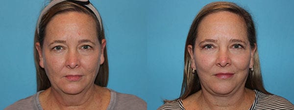 Facelift Before and after. Front facing