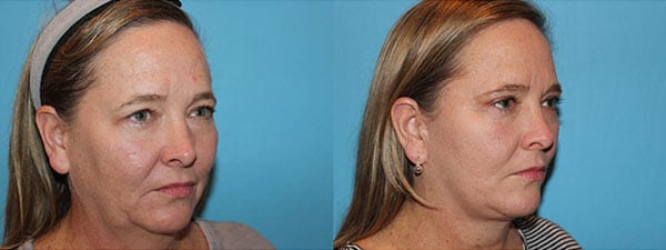Facelift Before and after. Side facing