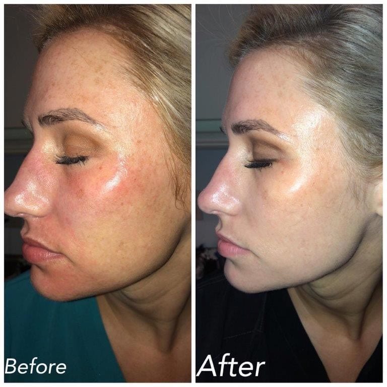 laser hair removal before and after face