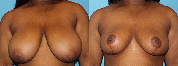 Breast Reduction before and after. Front facing