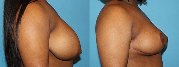 Breast Reduction before and after. Side facing