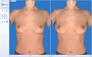 3D rendering of a before and after breast augmentation