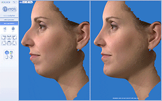3D rendering showing before and after of nose and chin procedures