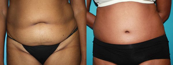 Tummy Tuck Patient before and after. Front facing