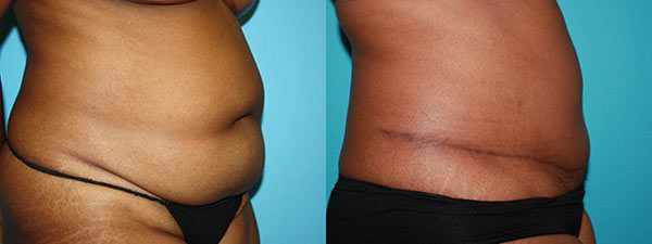 Liposuction Before and after. Facing the side.