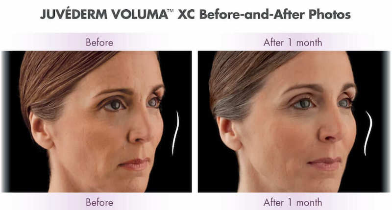 Juvéderm Voluma™ XC Before and After taken one month apart. 